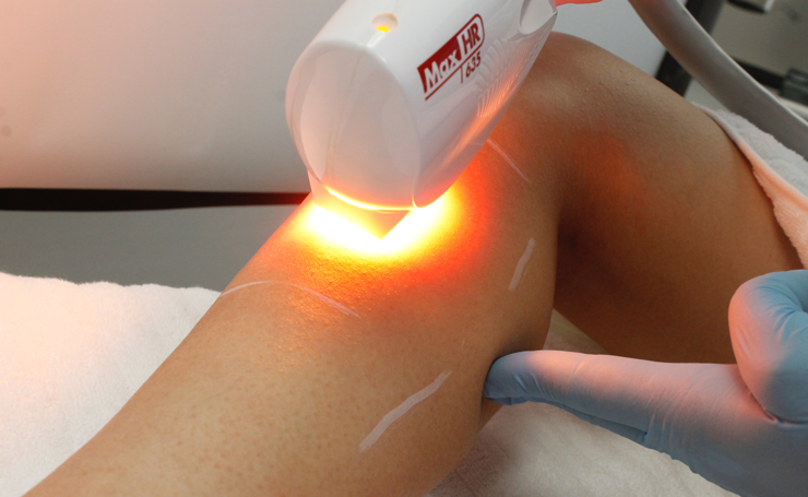 ipl laser services